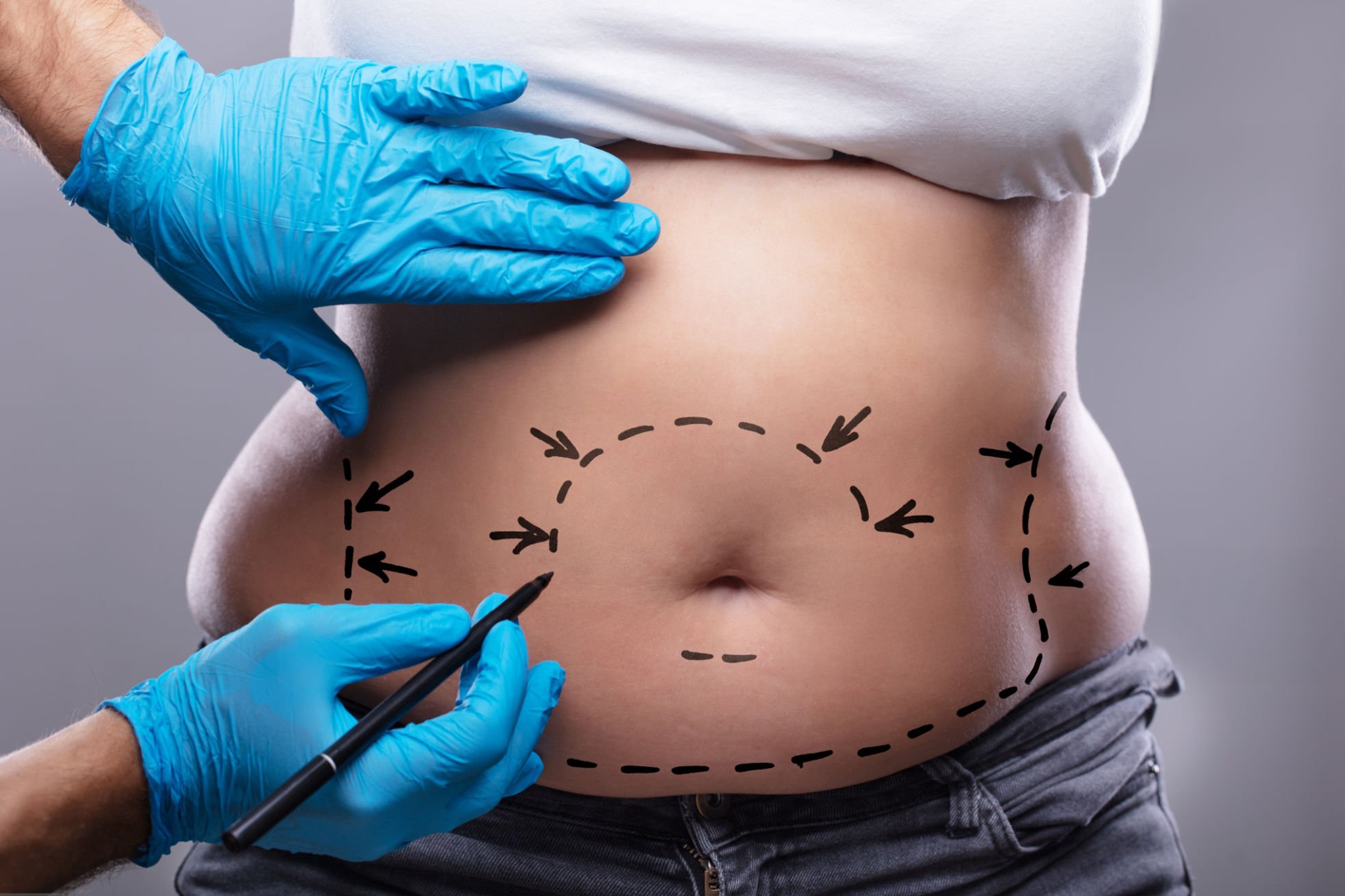 liposuction_2.jpg